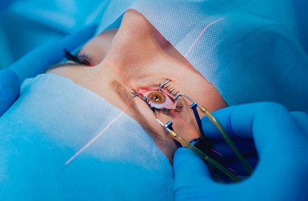 A close-up view of a patient undergoing LASIK Surgery, with a surgeon using specialized tools and a laser on the eye.